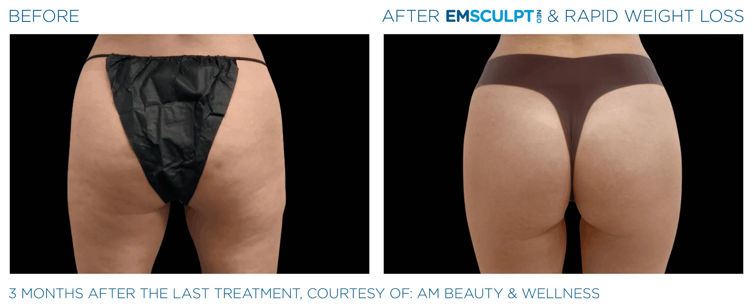 EMSCULPT NEO Buttock add volume