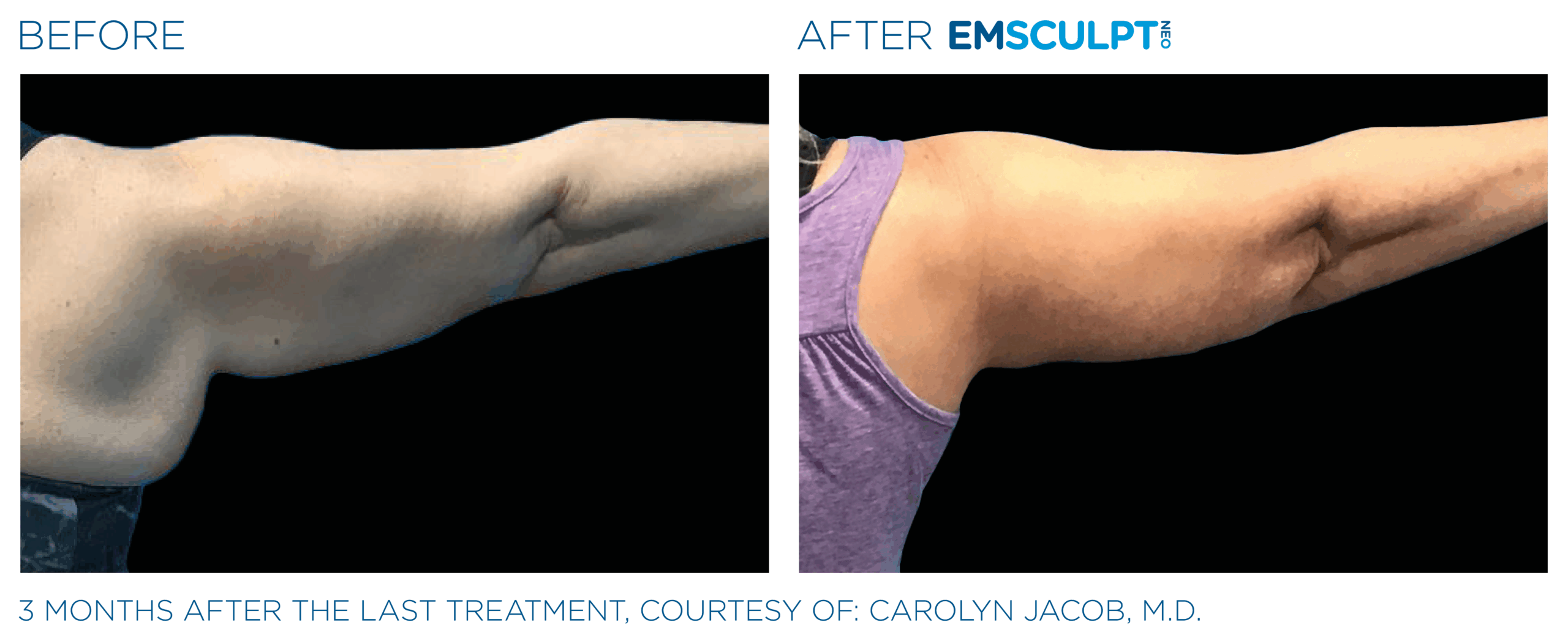 EMSCULPT NEO Arm shape and define