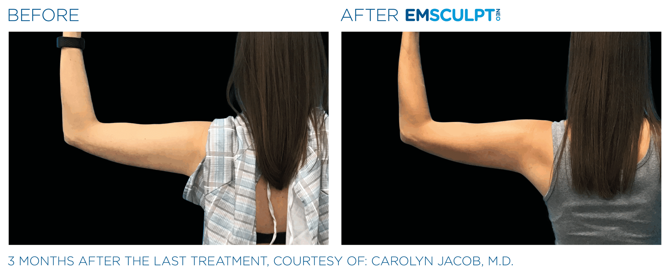 EMSCULPT NEO Arm shape and add muscle