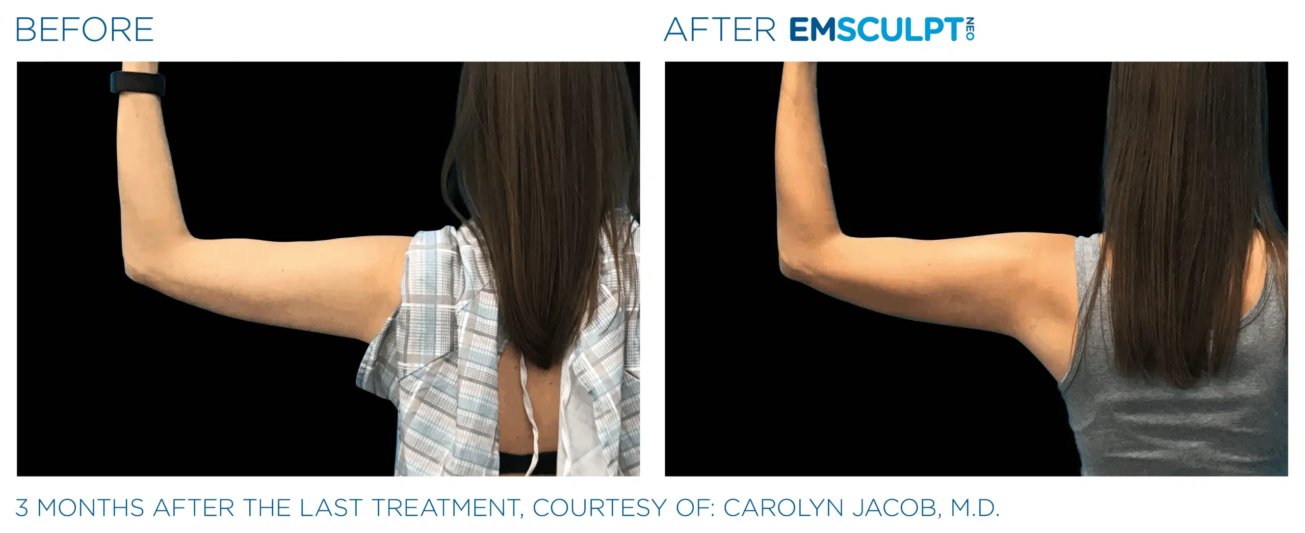 EMSCULPT NEO Arm shape and add muscle