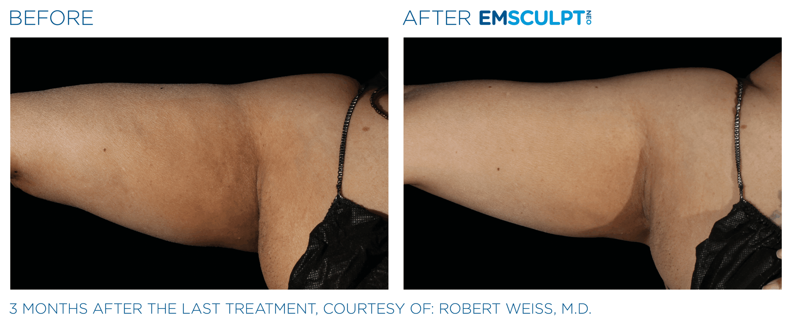 EMSCULPT NEO Arm firm and tone