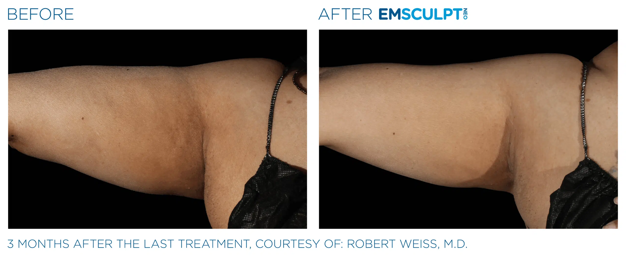 EMSCULPT NEO Arm firm and tone