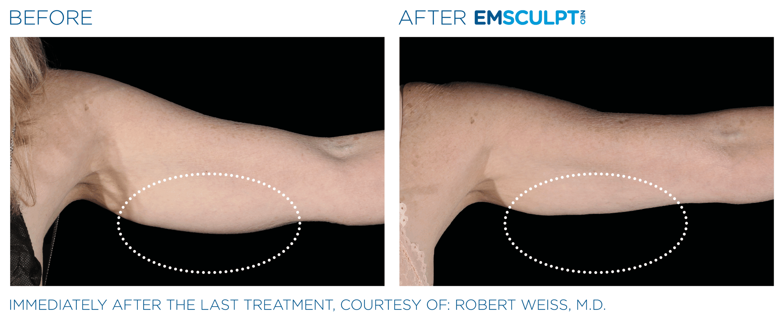 EMSCULPT NEO Arm tone and tighten skin