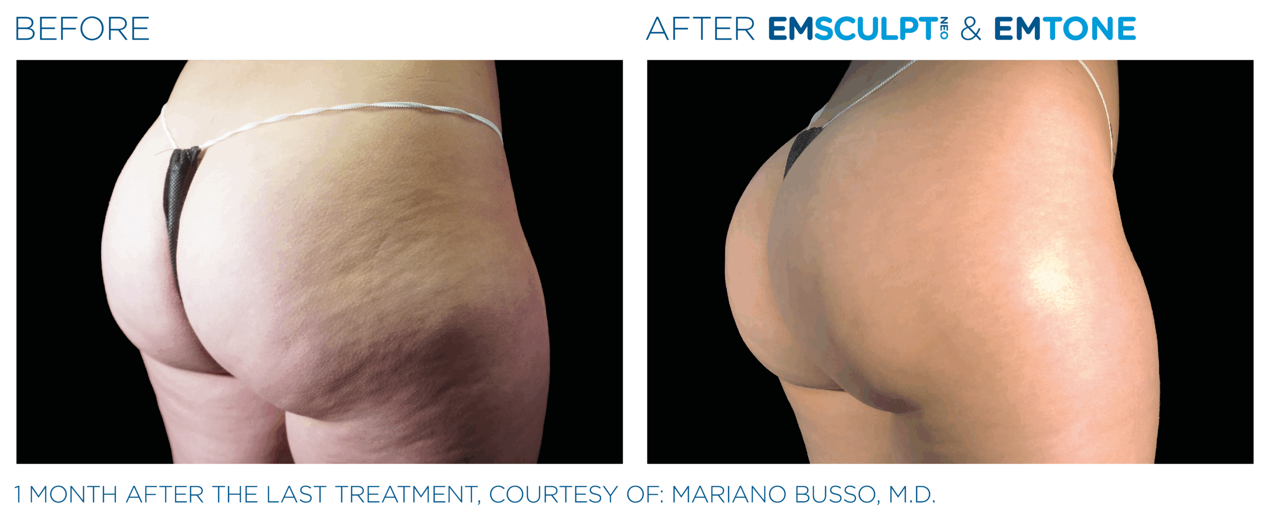 EMSCULPT NEO Buttock, lift and firm