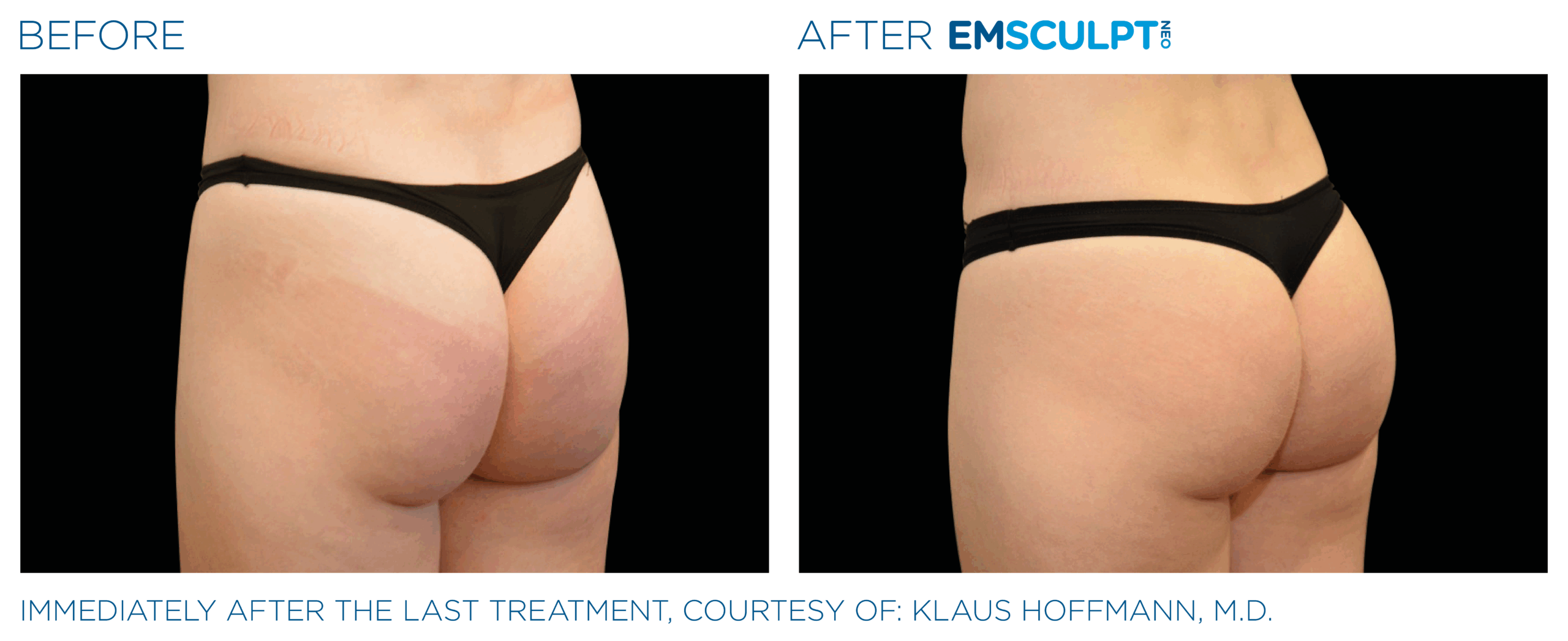 EMSCULPT NEO Buttock shape and tone