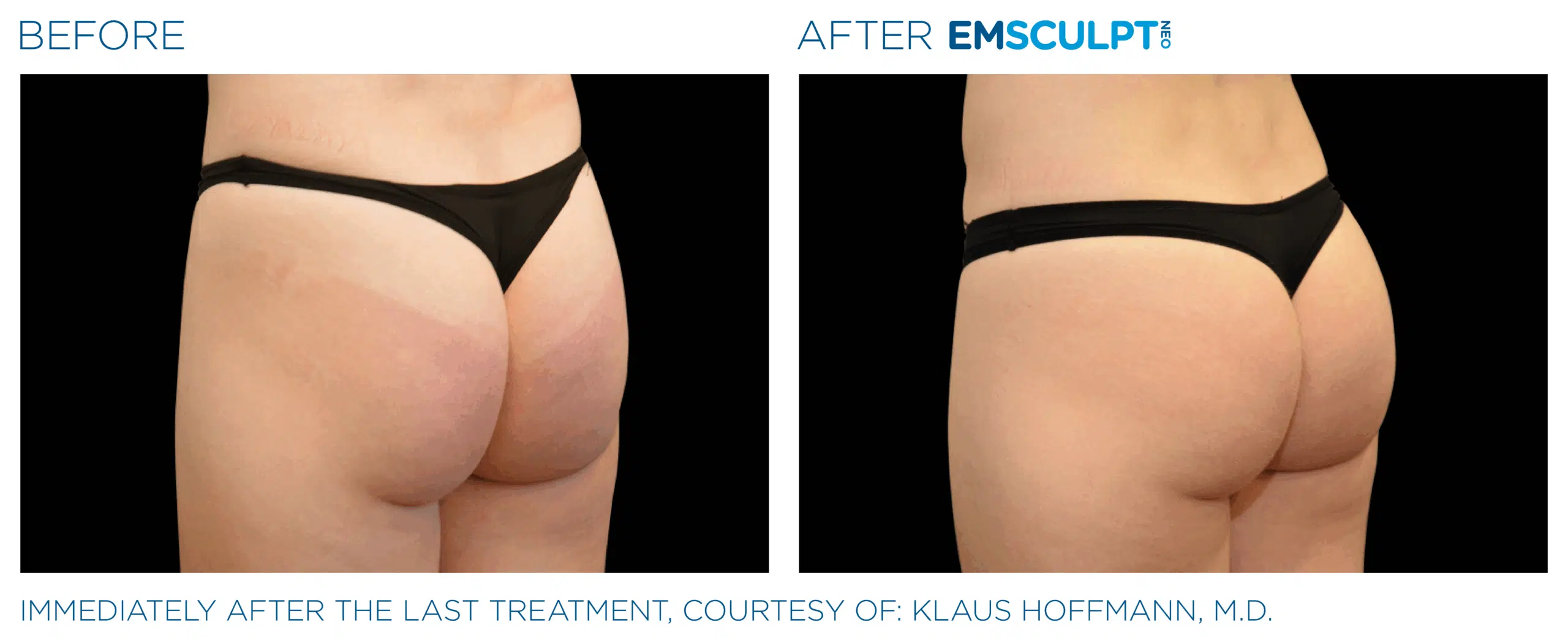 EMSCULPT NEO Buttock shape and tone