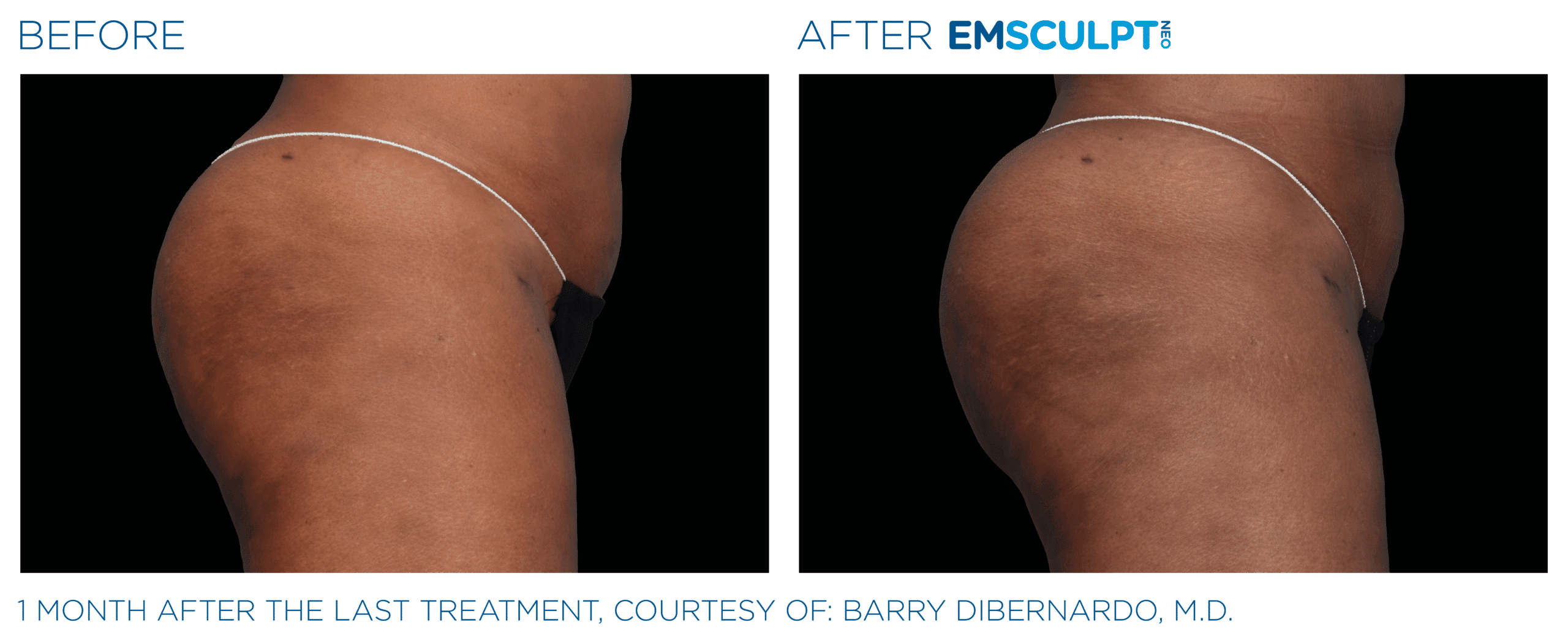 EMSCULPT NEO Buttock tone and lift