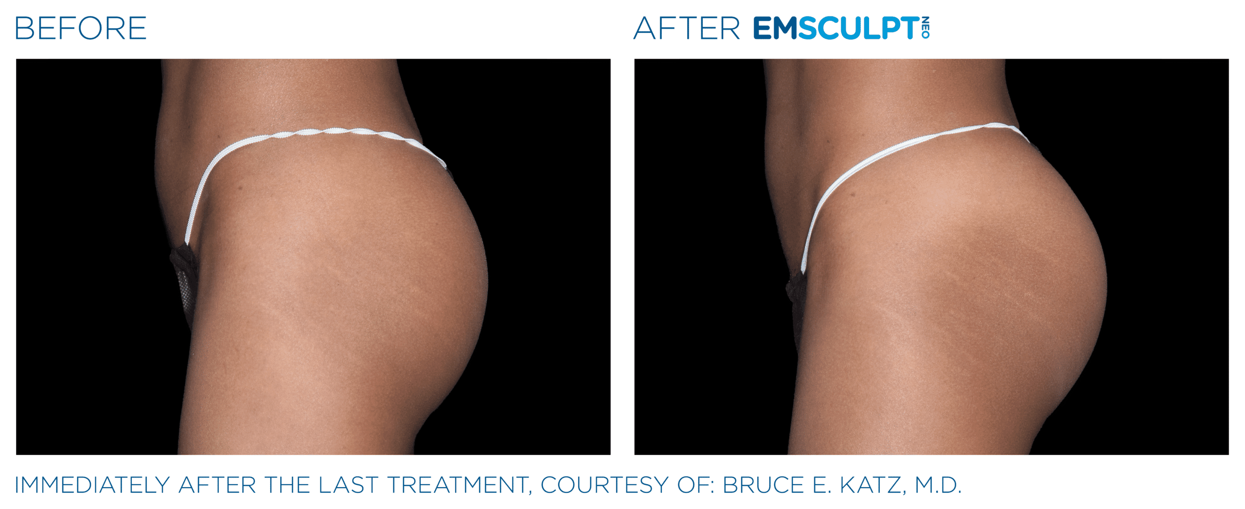 EMSCULPT NEO Buttock shape and tone