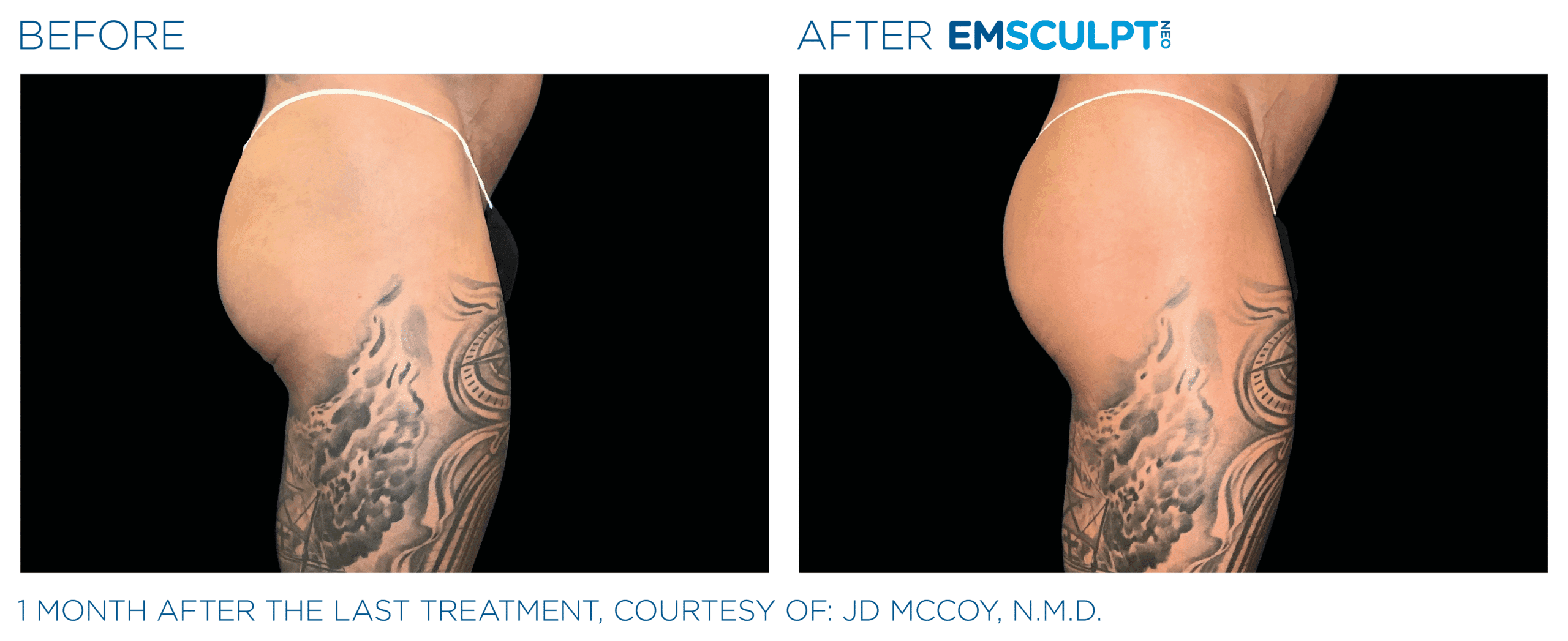 EMSCULPT NEO Buttock muscle toning