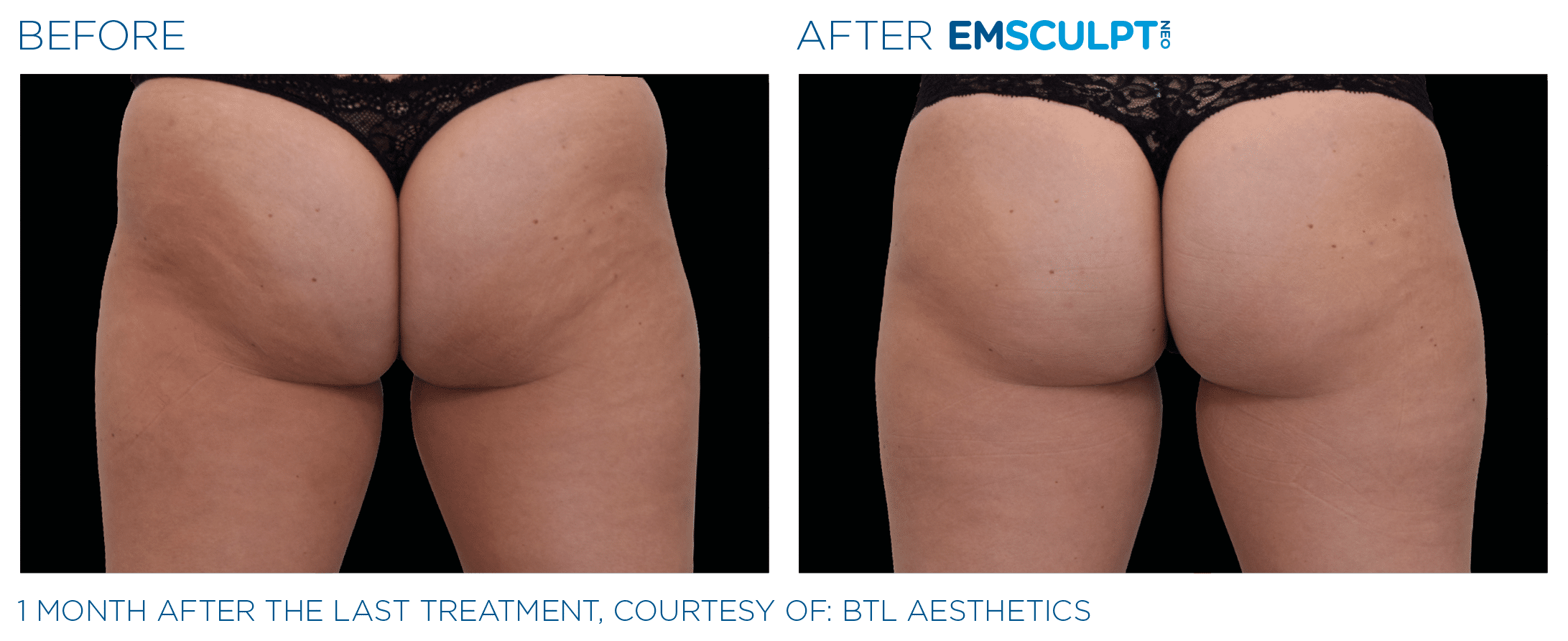 EMSCULPT NEO Butt shape and firm