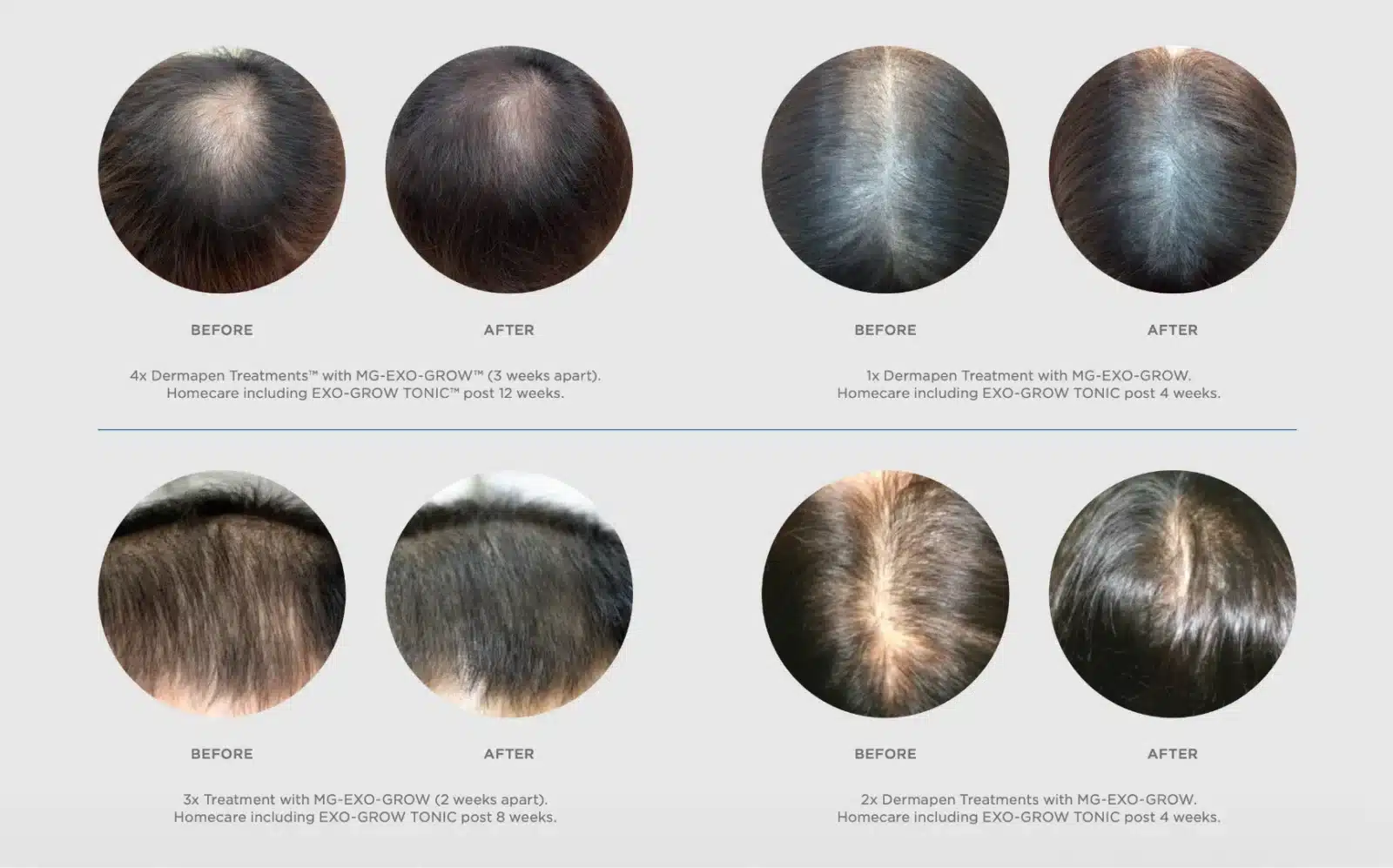 ExoGrow treatment hairline thickening