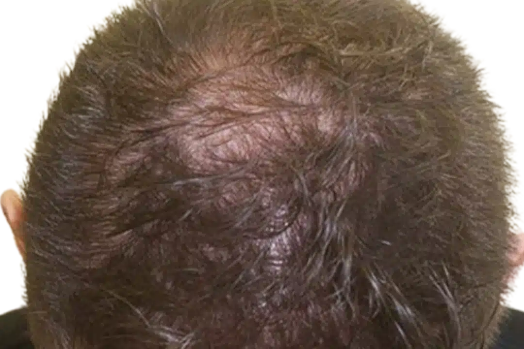 ExoGrow hair exosome treatment, after