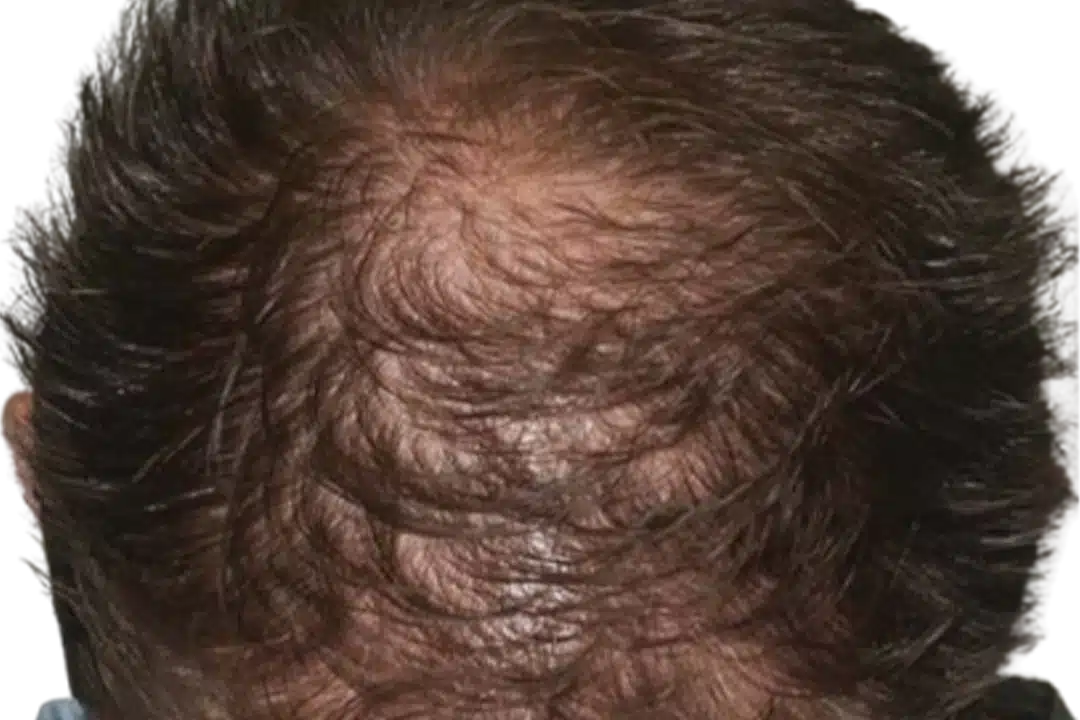 ExoGrow hair exosome treatment, before