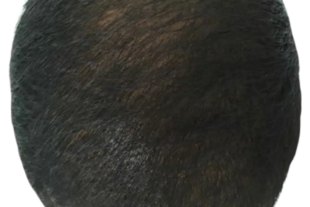 ExoGrow hair exosome treatment, after