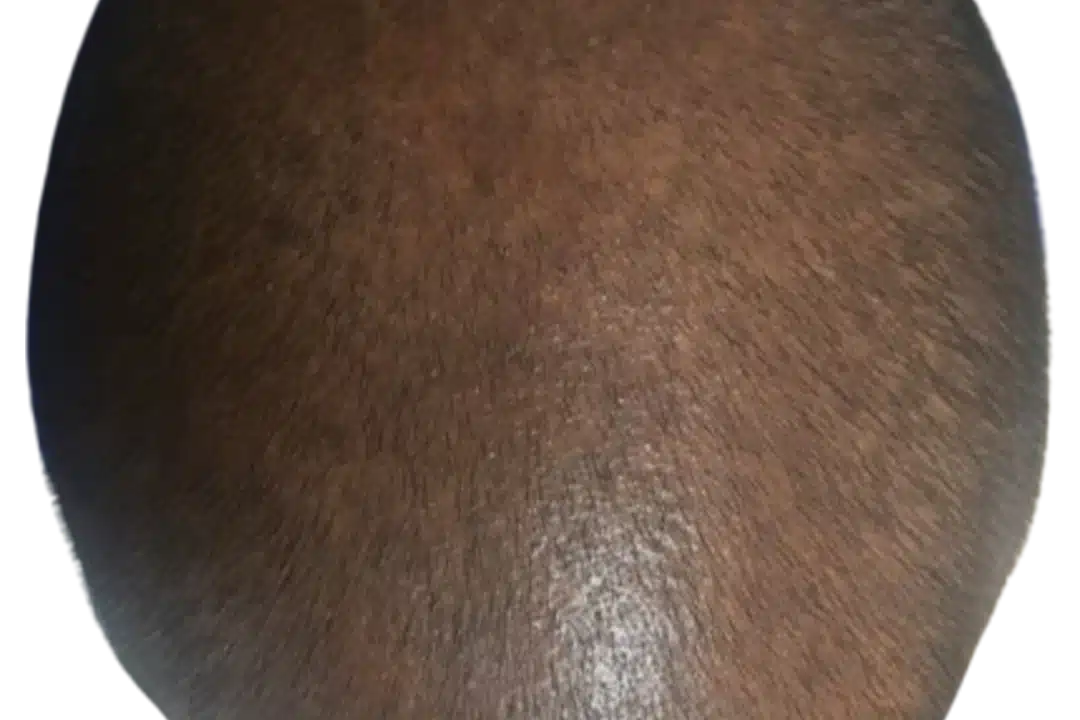 ExoGrow hair exosome treatment, before