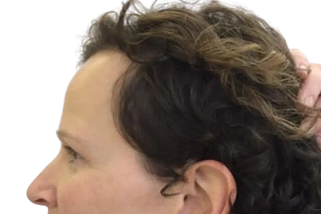 ExoGrow hair exosome treatment, after