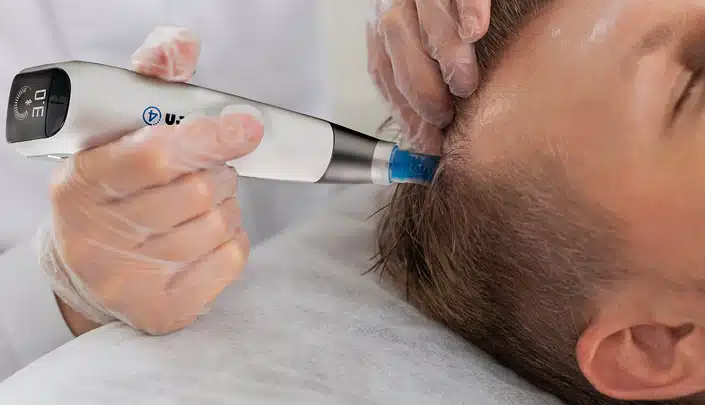 Exosome hair restoration with DP4 Microneedling