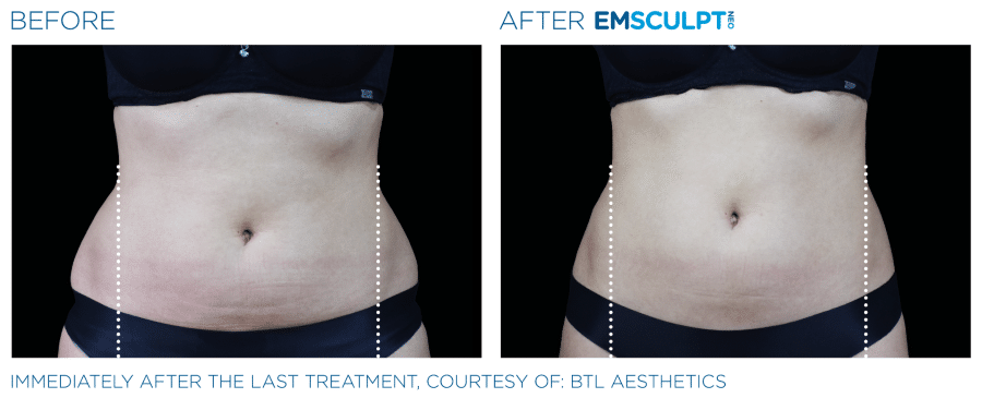 Abdomen EMSculpt NEO Before and After