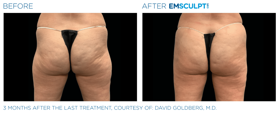 EMSculpt NEO Buttocks