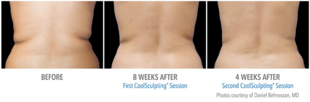 Before and After Fat Freezing