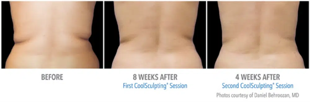 Before and After Fat Freezing