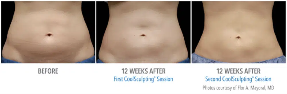 Fat Freezing Before and After
