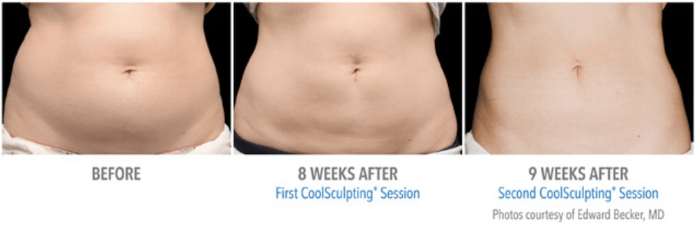 Fat Freezing Results