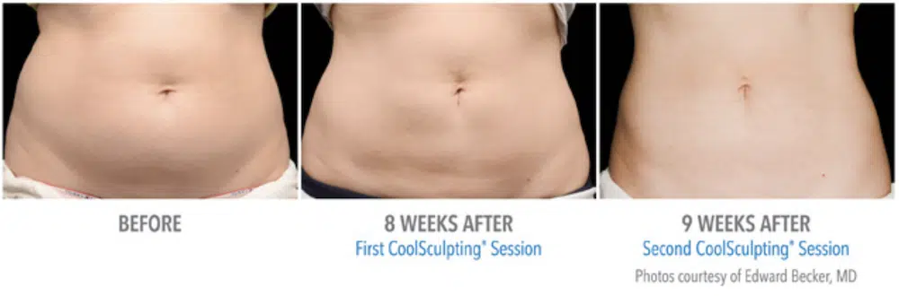 Fat Freezing Results