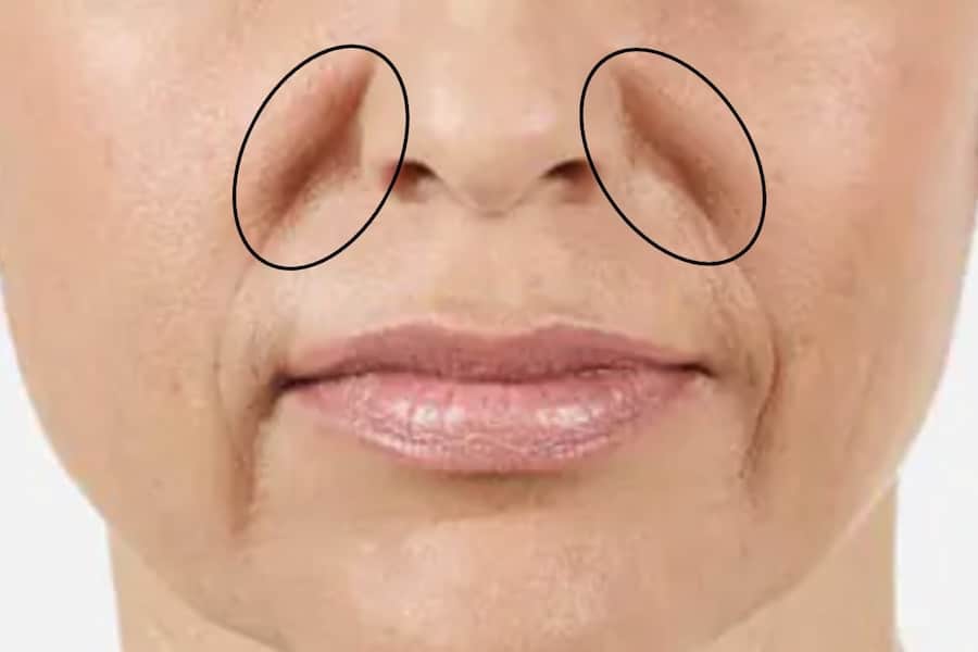 Nasolabial Folds