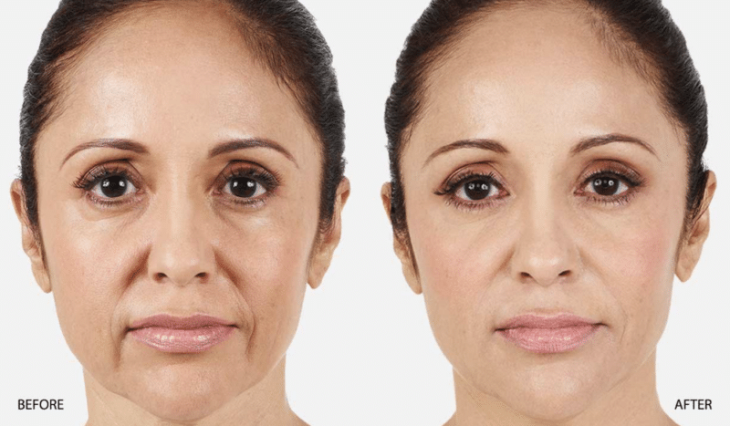 Smiles Lines Filler Before and After