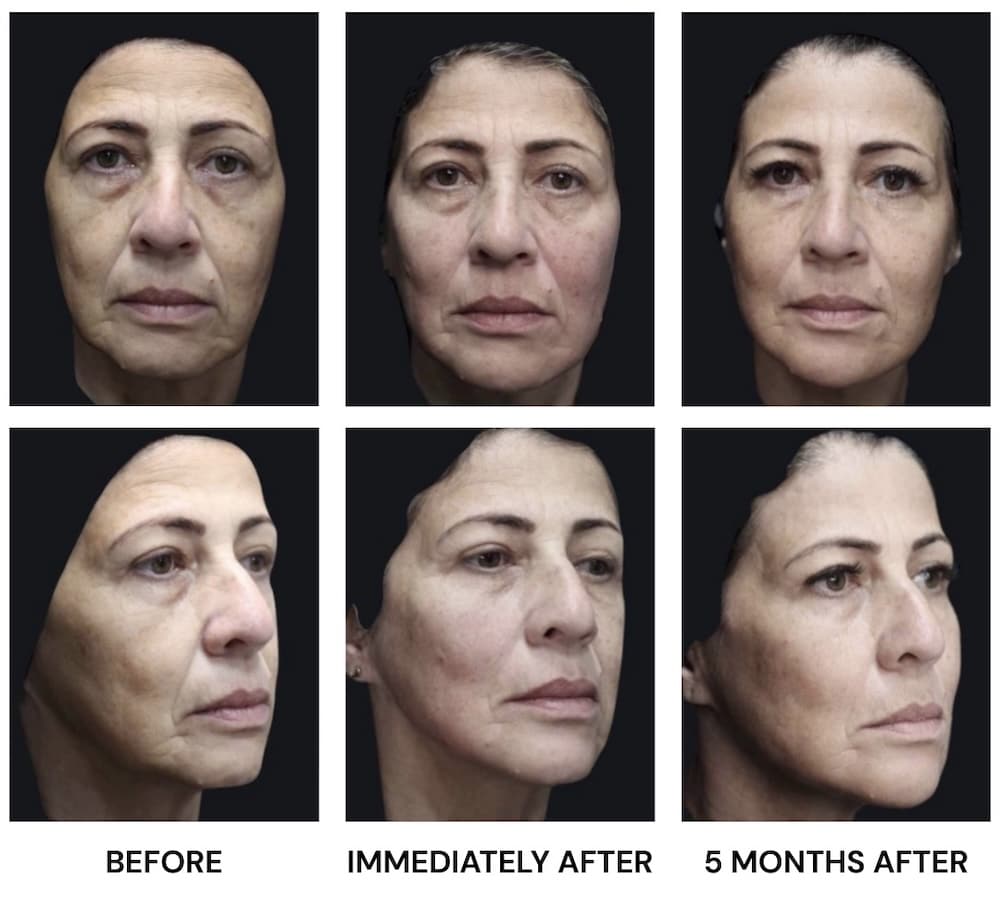 HArmonyCa Filler Results Over Time