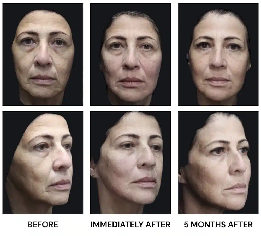 HArmonyCa Filler Results Over Time