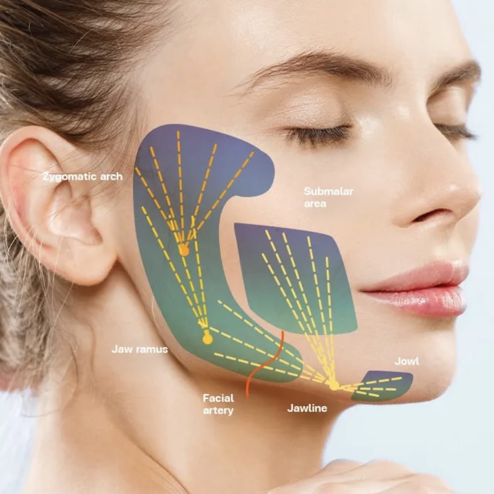 HArmonyCa Treatment Areas