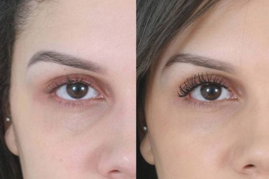 Under Eye Filler in Chicago, IL