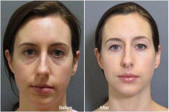 Filler Under Eyes