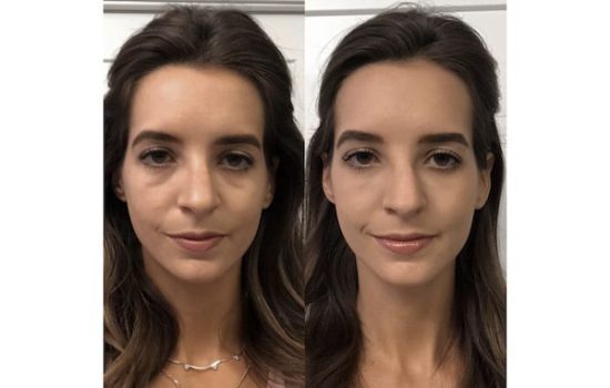 Tear Trough Filler Before and After