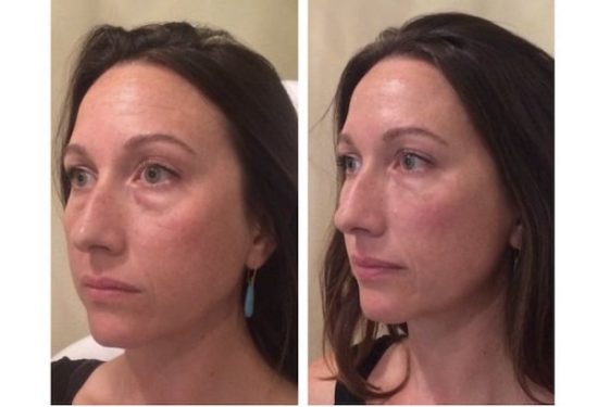 Under Eye Fillers Before and After