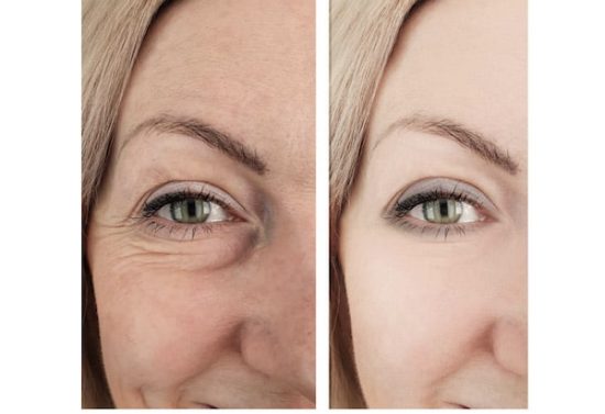 Under Eye Fillers